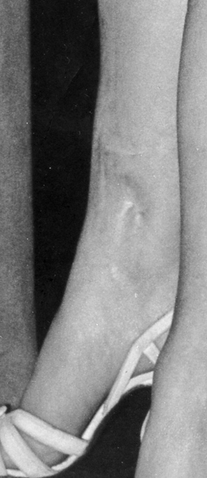Sabrina scars on leg